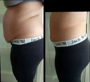 Kassen TruCryo before and after (stomach)