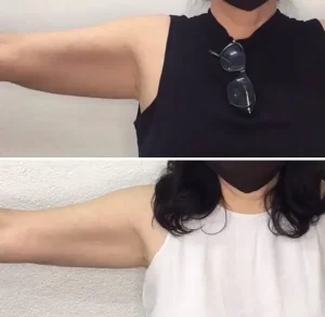 Kassen TruCryo before and after (under arm)