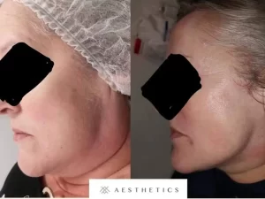Kassen TruCryo before and after (face)