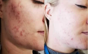 Kassen TruCryo before and after (face)