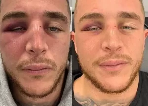 Kassen TruCryo before and after (face)