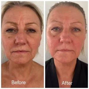 Neolifting - Before/After Results (11)