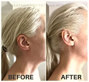 Neolifting - Before/After Results (4)