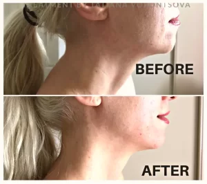 Neolifting - Before/After Results (5)