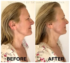 Neolifting - Before/After Results (6)