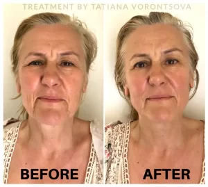 Neolifting - Before/After Results (7)