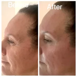 Neolifting - Before/After Results (8)