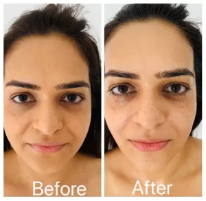 Neolifting - Before/After Results (9)