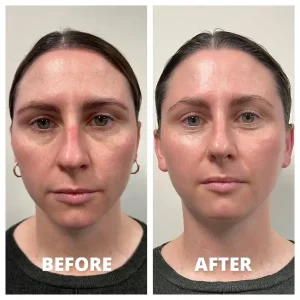 Neolifting - Before/After Results (1)