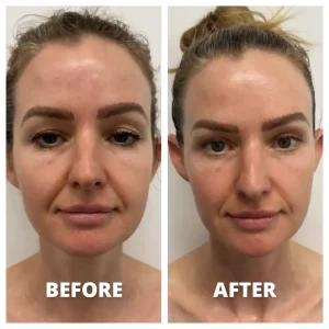 Neolifting - Before/After Results (10)