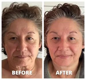 Neolifting - Before/After Results (12)