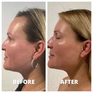 Neolifting - Before/After Results (2)