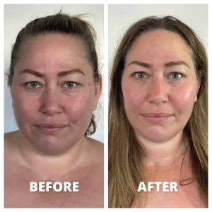 Neolifting - Before/After Results (3)